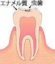 表面のエナメル質が溶け虫歯が始まった状態
