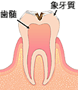 虫歯が象牙質まで達した状態