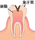 虫歯が歯髄にまで進行し大きな穴が開いた状態