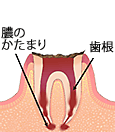 歯冠部（歯の頭の部分）が溶けて、歯根だけが残った状態