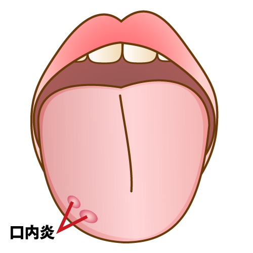 舌の口内炎のイラスト