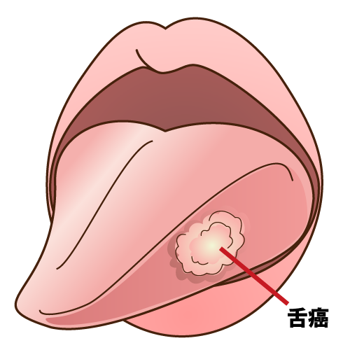 舌癌のイラスト