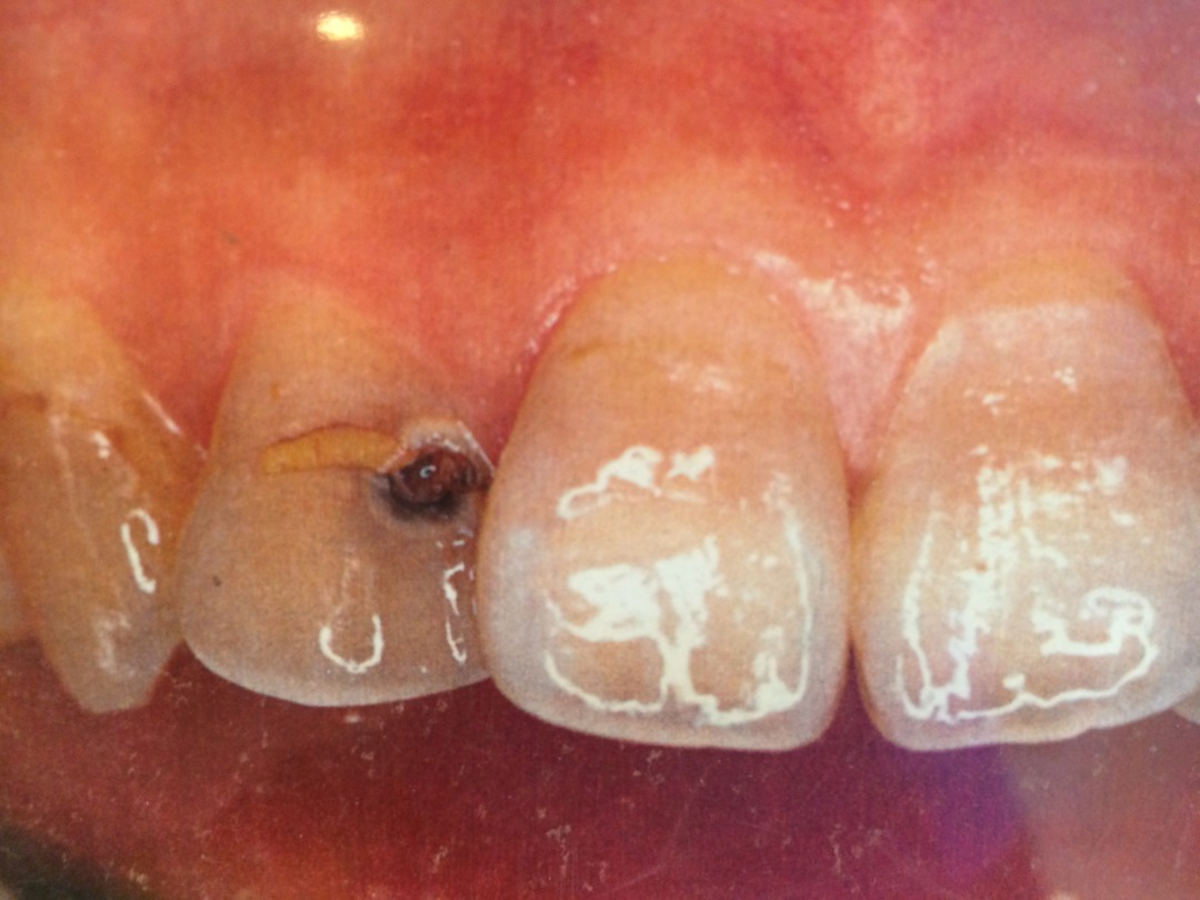 なぜ虫歯は黒くなるの 虫歯は歯磨きで治せるの 下高井戸の歯科治療 予防歯科 徒歩３分