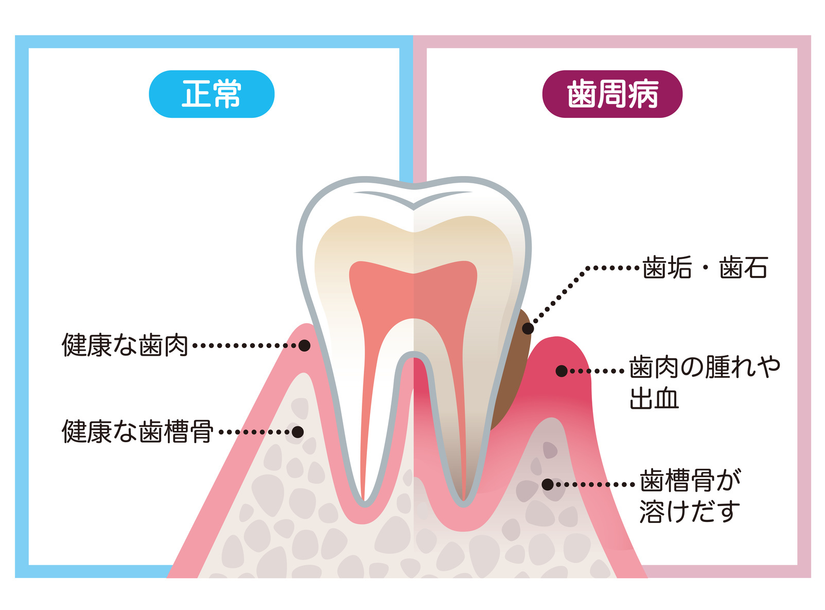 正常と歯周病の歯の比較イラスト